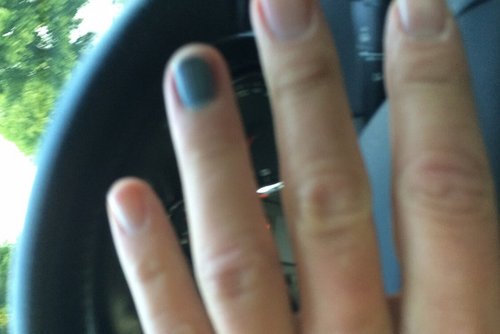 Blauer Nagel: Stefan Kapp hatte sich den Finger eingeklemmt