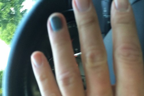 Blauer Nagel: Stefan Kapp hatte sich den Finger eingeklemmt Blauer Nagel: Stefan Kapp hatte sich den Finger eingeklemmt